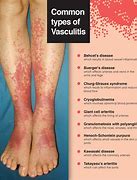 Image result for Vasculitis On Face