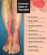 Image result for Vasculitis Leg Ulcers