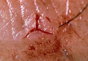 Image result for Human Bite Bruse