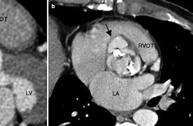 Image result for Left Ventricular Outflow Tract Stroke Volume