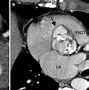 Image result for Anatomical Site of Left Ventricular Outflow Tract