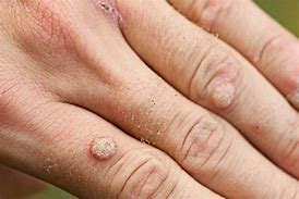 Image result for Benign Skin Bumps