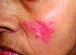 Image result for Atrophic Scar Treatment