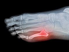 Image result for Broken Toe Bone