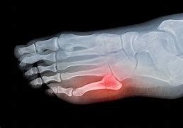 Image result for Broken Toe Bone