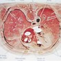 Image result for Pleural Diseases