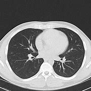 Image result for CT Chest Lung Window