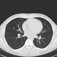 Image result for Lung Window CT