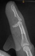 Image result for Jersey Finger X-ray