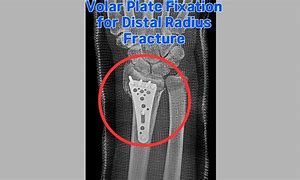 Image result for Volar Fracture