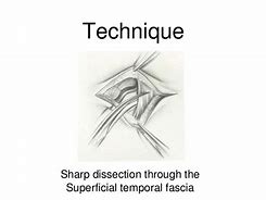 Image result for Temporal Artery Biopsy Technique