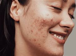 Image result for Pimple Face Wallpaper