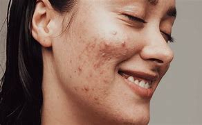 Image result for Pimple Face HD Images