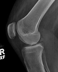 Image result for Normal Lateral View Knee