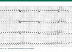 Image result for SVT vs VT ECG