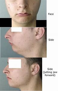 Image result for Recessed Chin Surgery