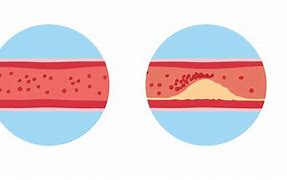 Image result for SCV Thrombosis