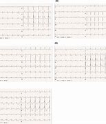 Image result for Heart Failure Electrocardiogram