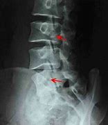 Image result for Pars Defect Lumbar Spine