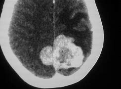 Image result for Subfalcine Meningioma CT