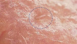 Image result for Pore Mites