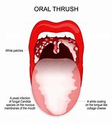 Image result for Candida Throat Infection