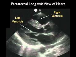 Image result for Angio Vue Choriocapillaris