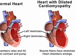 Image result for Dilated Cardiomyopathy EKG