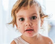 Image result for Pox Baby Girl