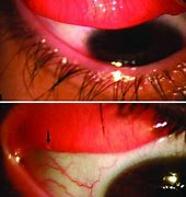 Image result for Tarsal Conjunctiva Papillae