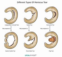 Image result for Complex Meniscus Tear Treatment