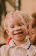 Image result for Child Boy Albino