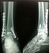 Image result for Displaced Lateral Malleolus Fracture