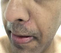 Image result for Pustules On Nose