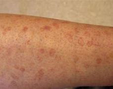 Image result for Dark Age Spots On Legs