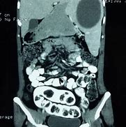 Image result for Cyst On Spleen