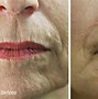 Image result for Upper Lip Wrinkles