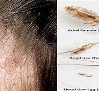 Image result for Lice Medication