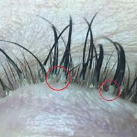 Image result for Mites On EyeLashes