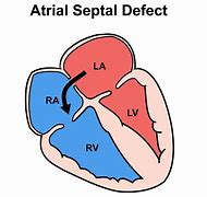 Image result for Atrial Septal Defect Blood Flow