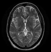 Image result for Hepatic Encephalopathy MRI