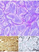 Image result for Neuropil Medulloblastoma