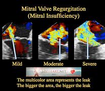 Image result for Moderate MR.HEART