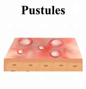 Image result for Pustules Skin Disease