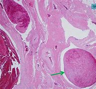 Image result for Thrombosis Histology