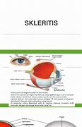 Image result for Skleritis