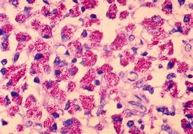 Image result for Mycobacterium Avium Infection