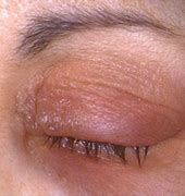 Image result for Tarsal Conjunctiva Papillae