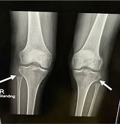 Image result for Deformity of Fibular Head