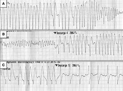 Image result for AFib vs V-fib